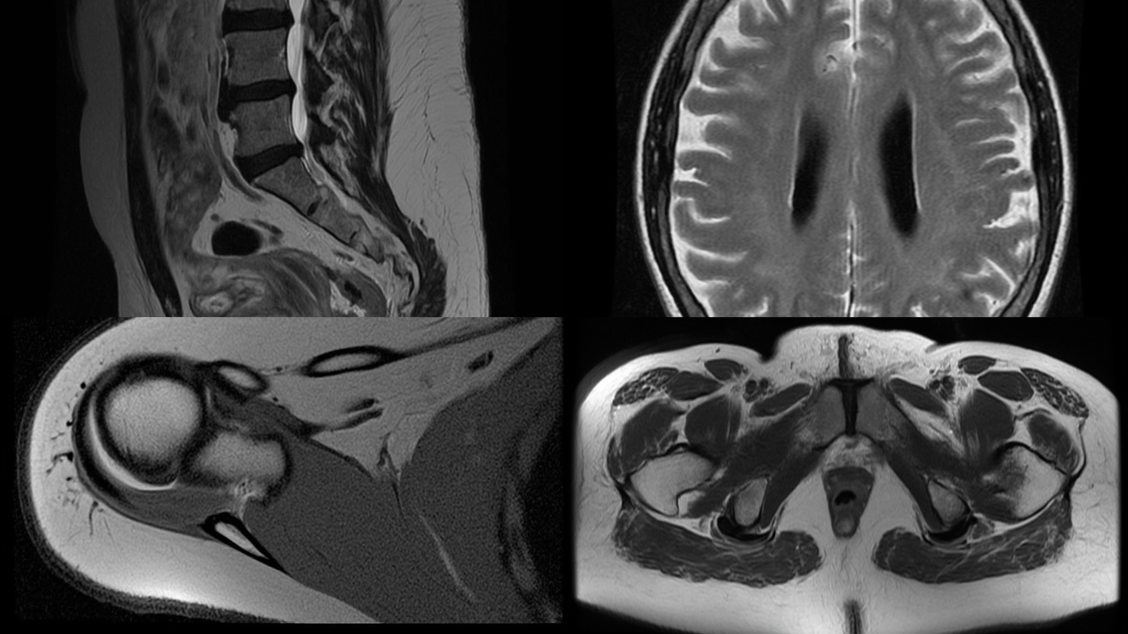 MRI Scan
