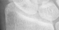 DistalRadius.bmp