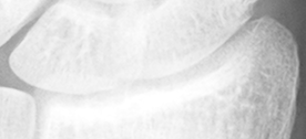 DistalRadius.bmp