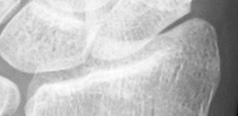 DistalRadius.bmp