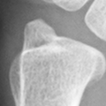 DistalUlna.bmp