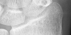DistalRadius.bmp