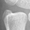DistalUlna.bmp