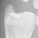 DistalUlna.bmp