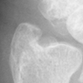 DistalUlna.bmp