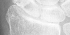 DistalRadius.bmp