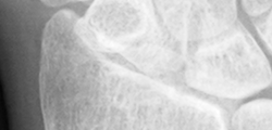 DistalRadius.bmp