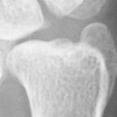 DistalUlna.bmp