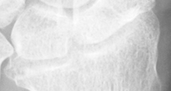 DistalRadius.bmp