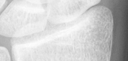 DistalRadius.bmp