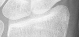 DistalRadius.bmp