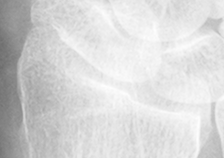 DistalRadius.bmp