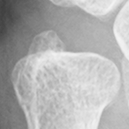 DistalUlna.bmp